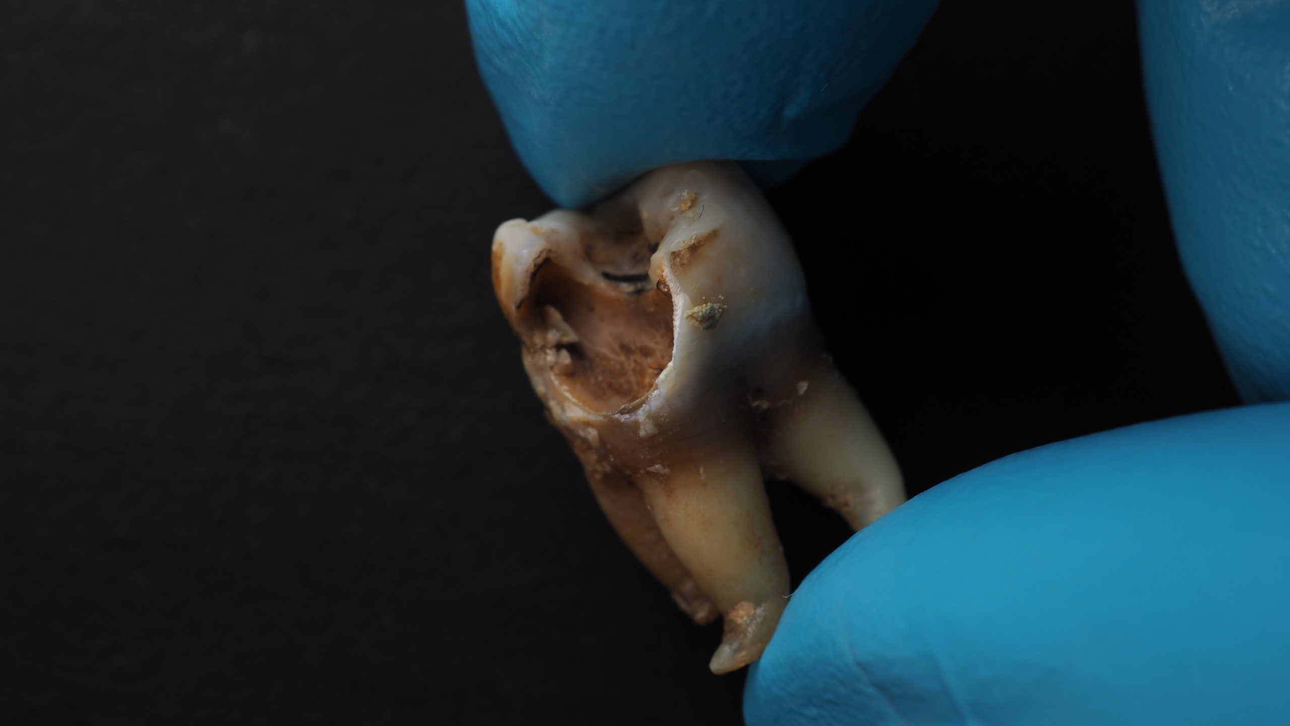 Endodontics consultation in albania